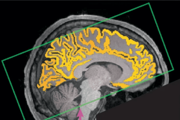 Per la mancanza di sonno il cervello è in balia di ondate incontrollate